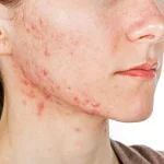 Key Factors That Influence Acne Prevention and Save Time