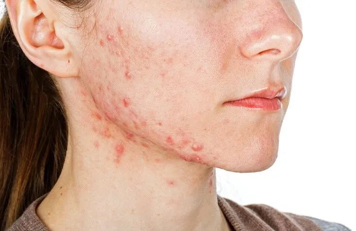 Key Factors That Influence Acne Prevention and Save Time