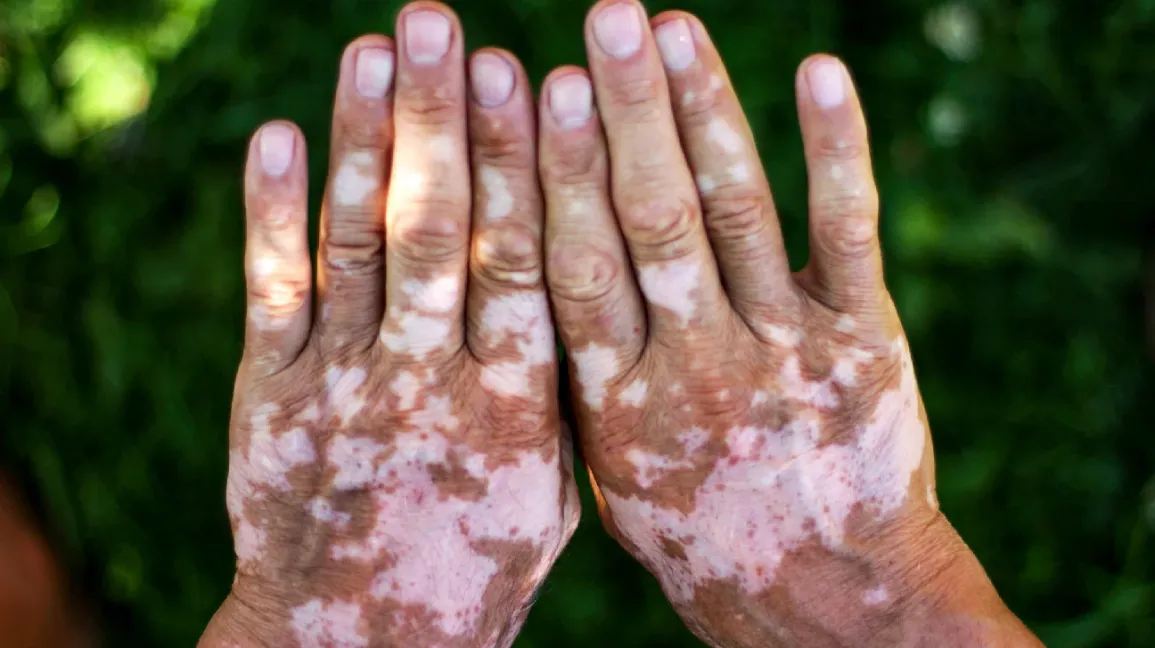 Skin Conditions That Signal Internal Health Problems and Their Treatments